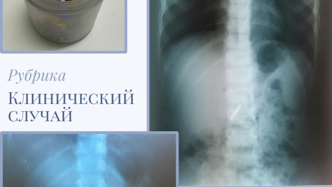 В Балаково врачи помогли детям, проглотившим монету и колпачок от флеши